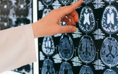 Microplastics detected in human Brain: Unseen pollution’s silent threat